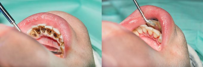 Plaque Of The Patient, Stone. Dentistry Treatment Of Dental Plaq