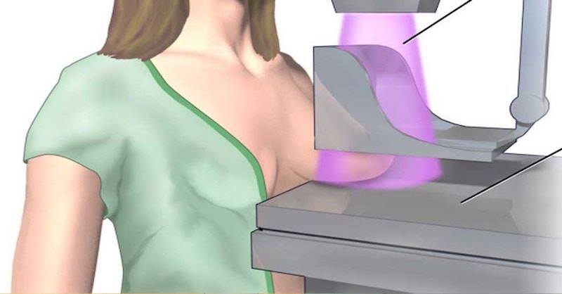 Dosud největší studie o mamografii zjistila, že jsou zcela zbytečné a navíc nebezpečné