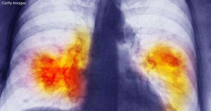 lung-cancer-pictures-fresh-lung-cancer-what-doctors-want-you-to-know-of-lung-cancer-pictures-696x365