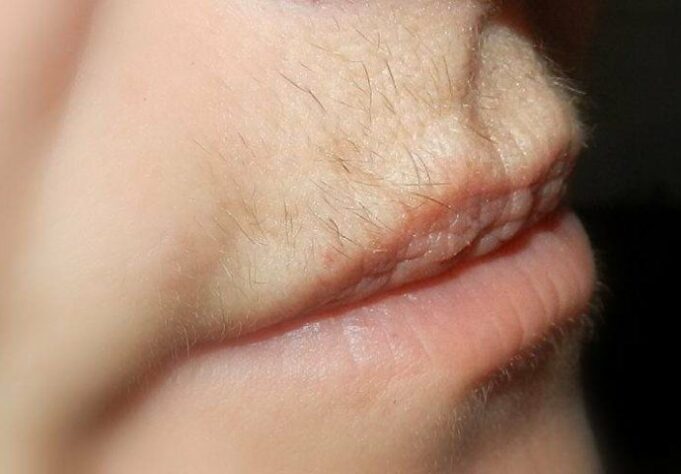 5c0154b2-ce8c-483f-8fb9-21ea0a0a0a67-dlacice-na-licu-690x480-1