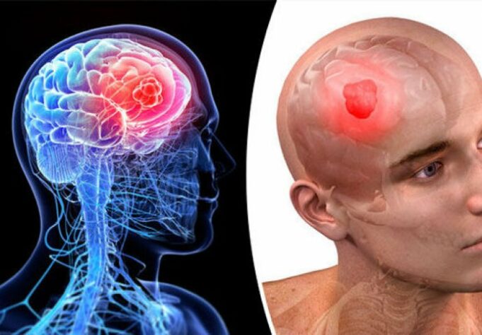 62f2c3f6-5f14-4436-aaab-4ccc0a0a0a64-tumor-mozga-690x480