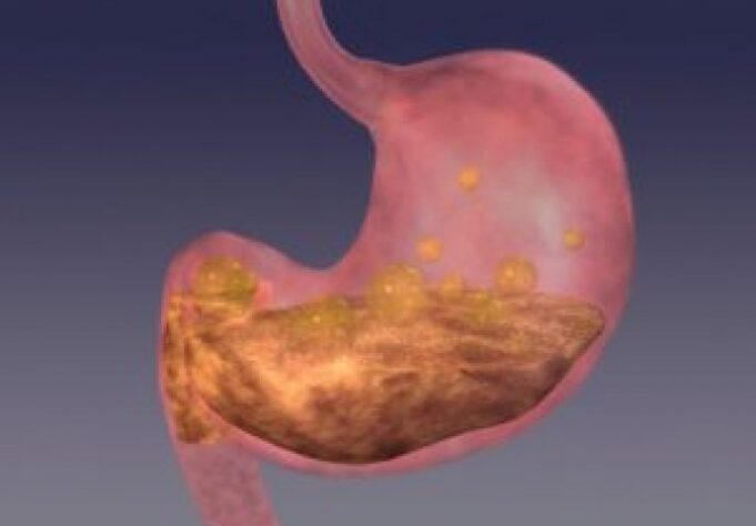 5ba7914f-c284-4918-a6a1-467c0a0a0a67-antral-gastritis-300x225-690x480