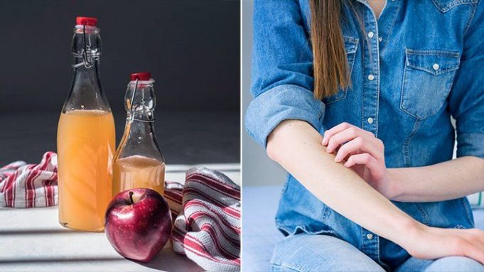 can-apple-cider-vinegar-help-eczema-and-atopic-dermatitis-722x406